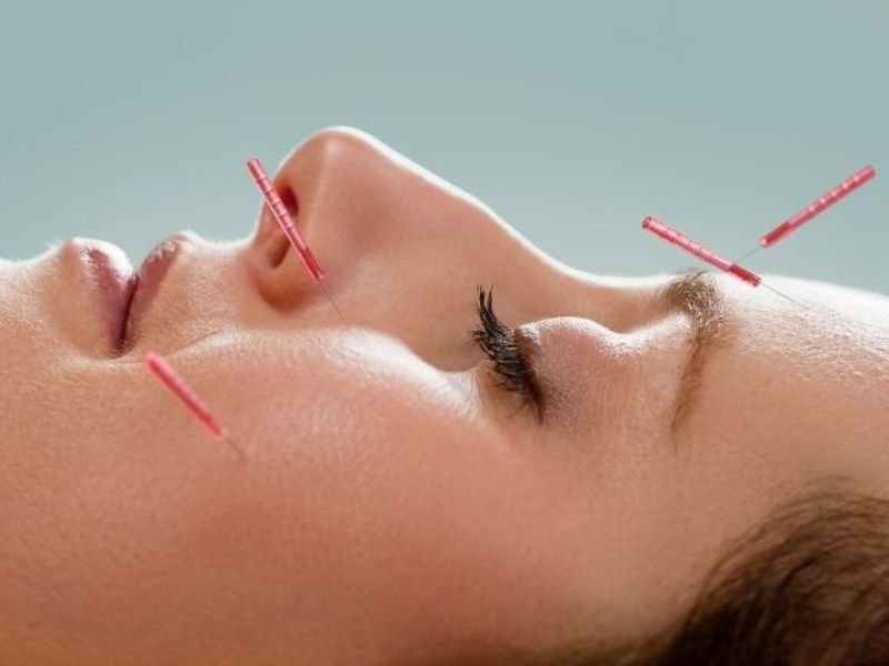 Acupuntura Facial Anti-Rugas — Five Bewell Lisboa